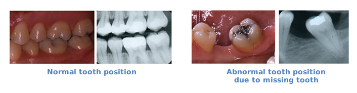 false-teeth-2