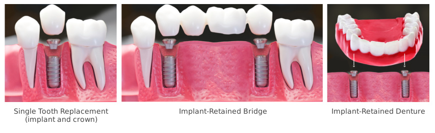 implants