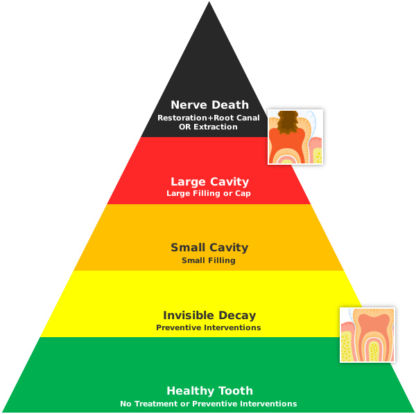 tooth-decay-triangle