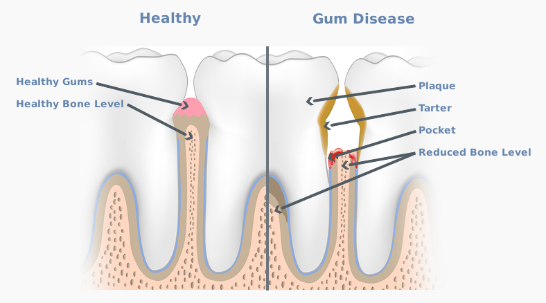 gum-disease-full